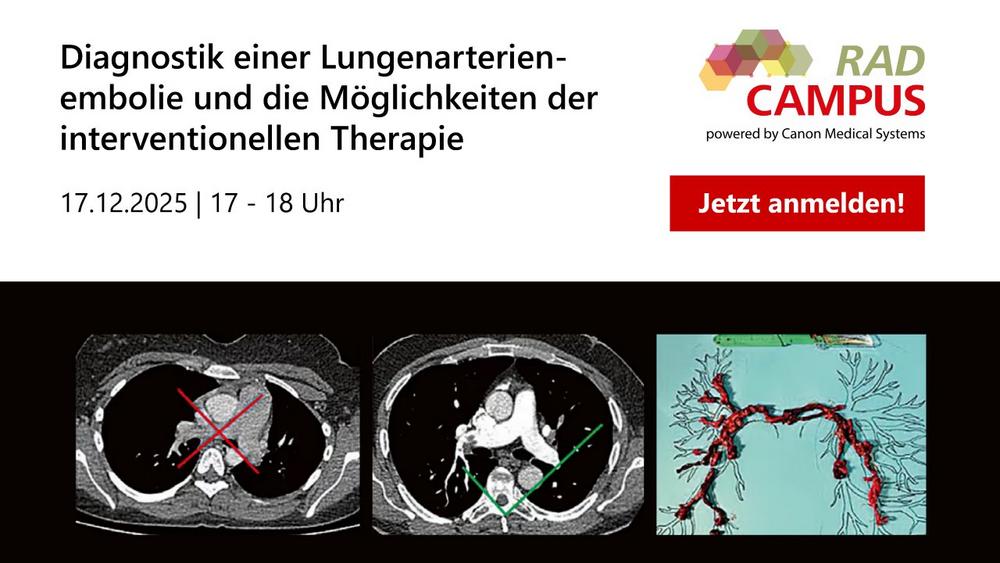 Diagnostik einer Lungenarterien­embolie und die Möglichkeiten der interventionellen Therapie (Webinar | Online)